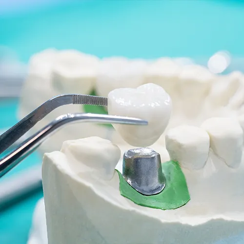 tweezers placing crown on implant in plaster jow model