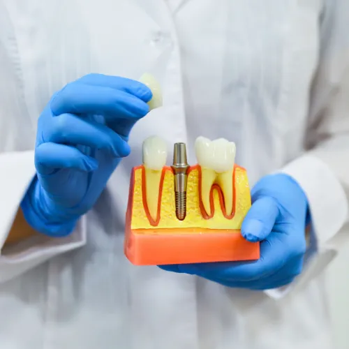 Model of an implant between two teeth.