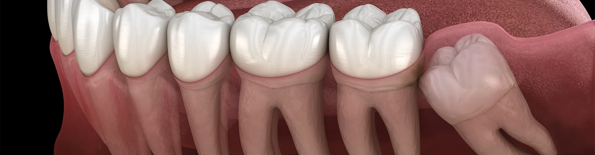 Rendering of a manidble with impacted wisdom tooth.
