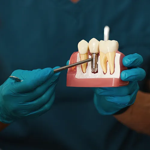 gloved hands holding implant model