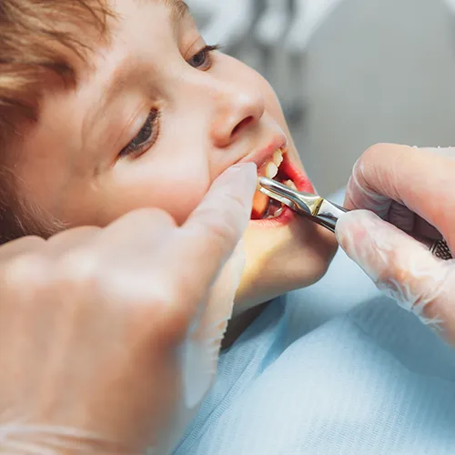 gloved hands using dental tool to pull child's tooth